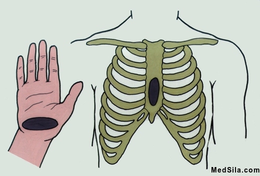 Слева – область нижней руки, которая должна давить на грудную клетку. Справа - область груди, куда необходимо давить при СЛР.