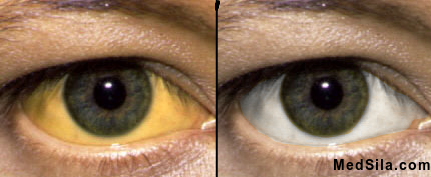 Желтушное (слева) и обычное (справа) окрашивание склер.