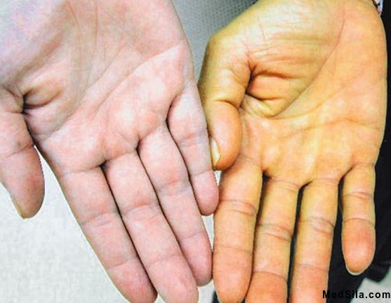 Нормальное (слева) и желтушное (справа) окрашивание кожи рук.