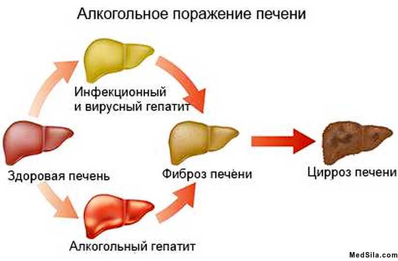 Этапы формирования цирроза
