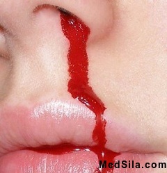 носовое кровотечение