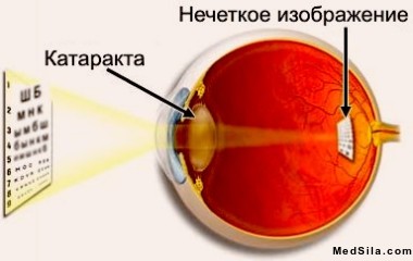 Изменение изображения при катаракте