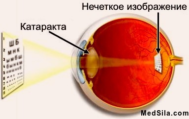 Изменение изображения при катаракте