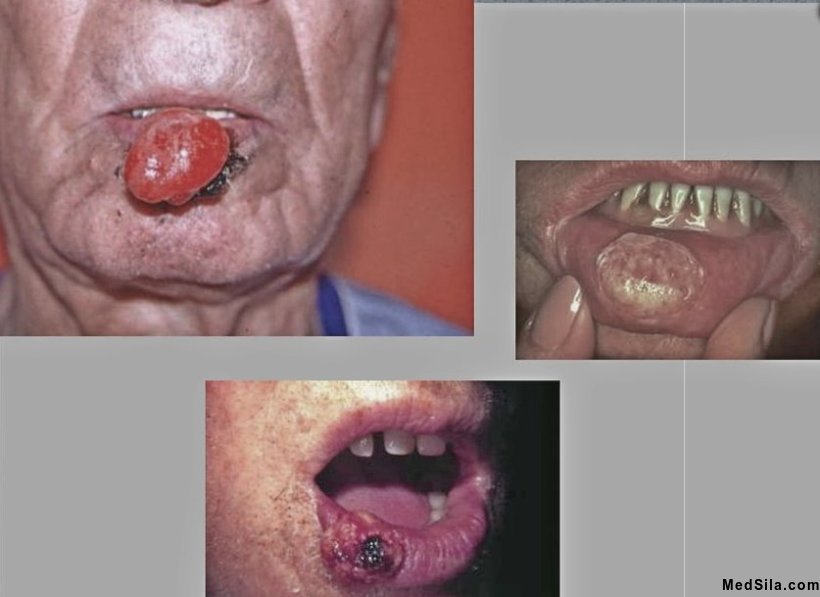 рак губы
